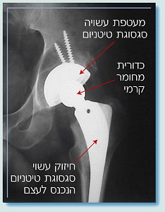 תמונה של עצם ירך מקובעת בעזרת כדורית העשויה מחומר קרמי